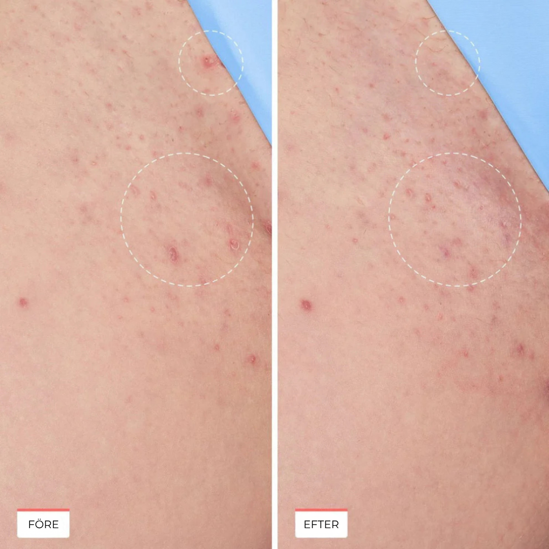 Calméa™ Ingrown Serum | Trött på smärtsam rakning och irriterande utslag? Upptäck lösningen som alla pratar om!