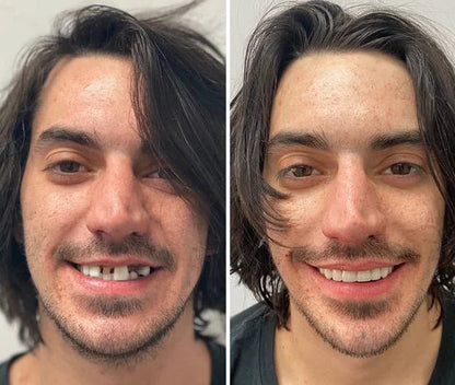 Holdent™ lim | Det termoplastiska proteslimmet som håller dina tänder på plats i 4 dagar utan att lossna.