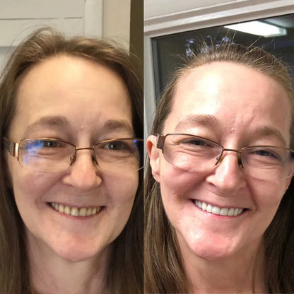 Holdent™ lim | Det termoplastiska proteslimmet som håller dina tänder på plats i 4 dagar utan att lossna.