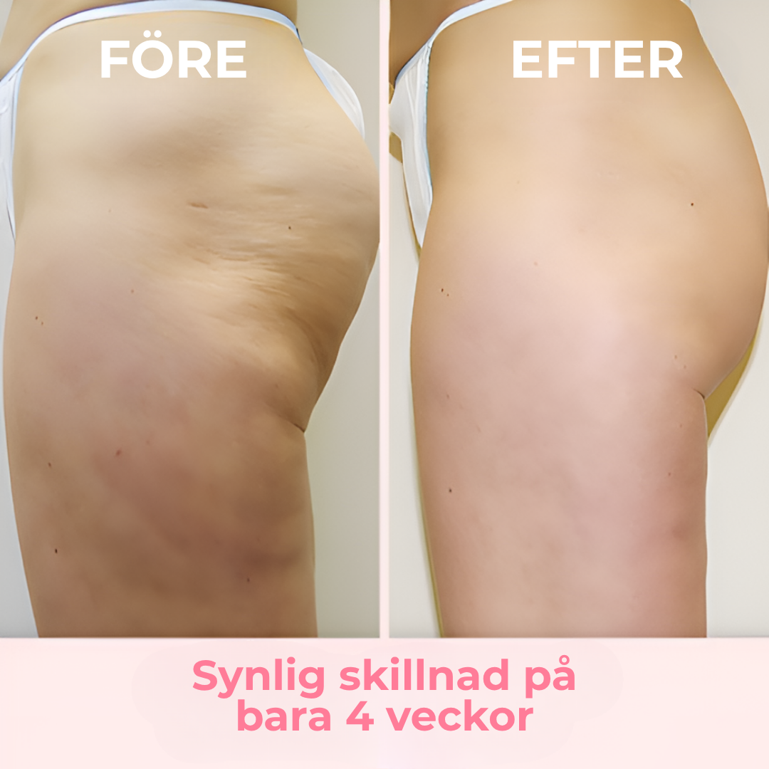 SkinSculpt™ | Usuń cellulit – Zobacz i poczuj różnicę już po kilku tygodniach