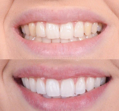 SmileBright™ tandblekningspenna | Professionell tandblekning hemma