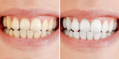 SmileBright™ tandblekningspenna | Professionell tandblekning hemma