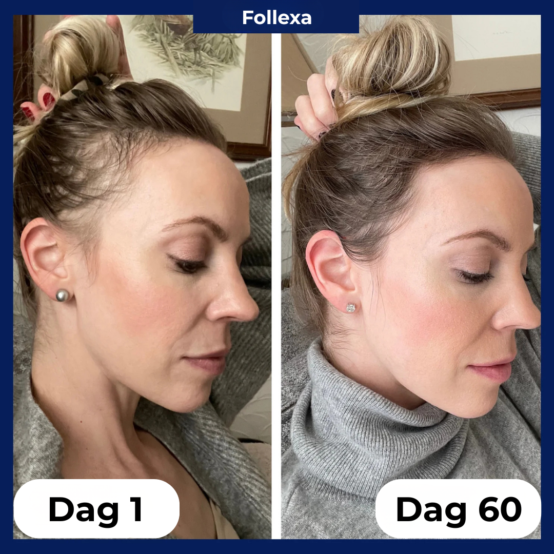 Follexa™ Hair Roll-On System | Återupptäck Ditt Hår – Fylligare, Starkare och Mer Livskraftigt!