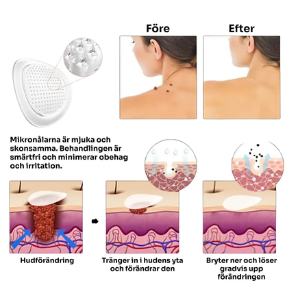 SkinoPlaster™ Pro MicroDarts TAG'Gone | Ta bort hängande födelsemärken smärtfritt – utan ärr, utan snitt, utan stress!