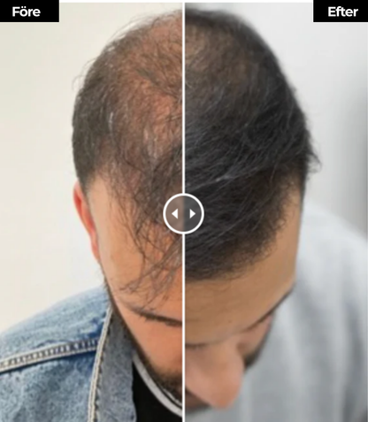 VitaRay™ | Få tillbaka ditt tjocka, levande hår – utan smärta eller mediciner!