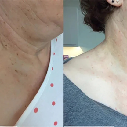 SkinoPlaster™ Pro MicroDarts TAG'Gone | Ta bort hängande födelsemärken smärtfritt – utan ärr, utan snitt, utan stress!