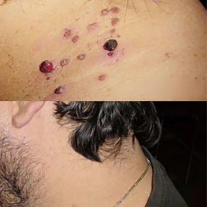 SkinoPlaster™ Pro MicroDarts TAG'Gone | Ta bort hängande födelsemärken smärtfritt – utan ärr, utan snitt, utan stress!